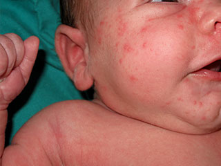 Acne neonatourm