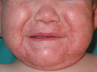 Dermatitis atópica